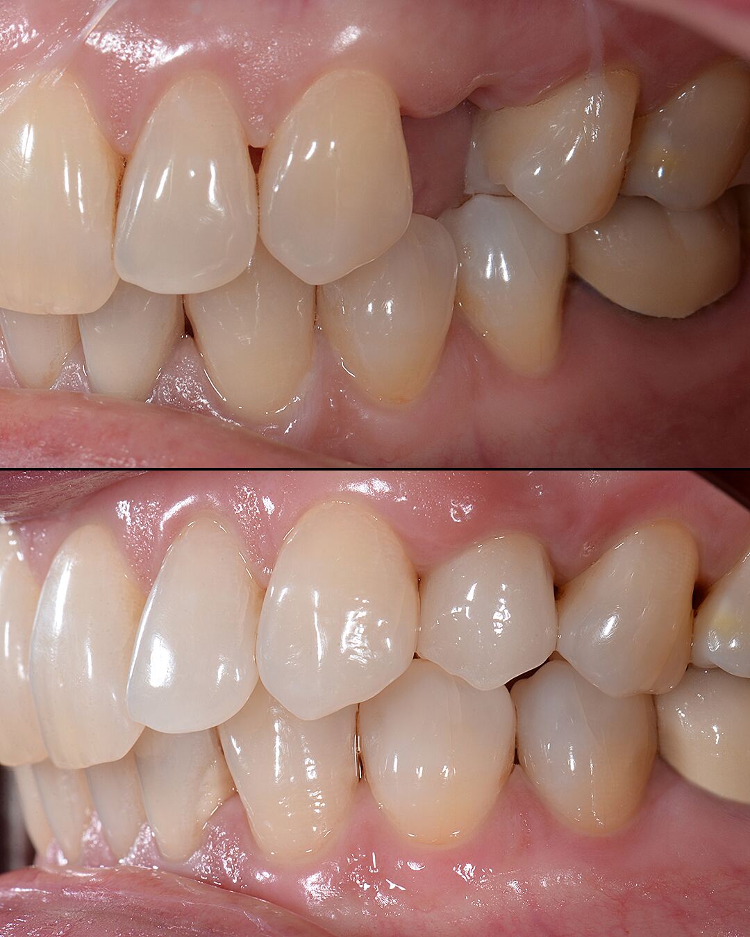 Before and after — missing back molar replaced with dental implant