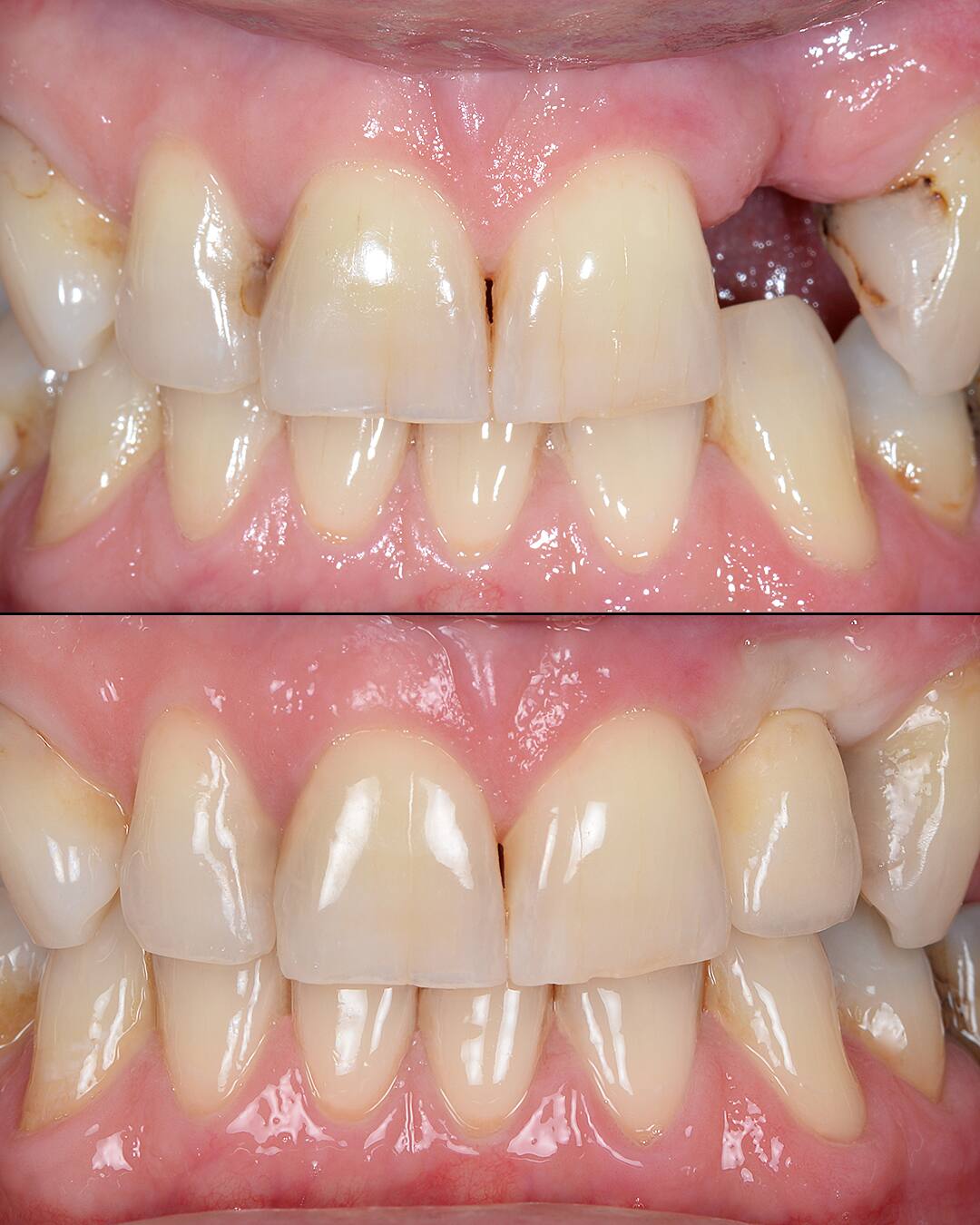 Patient smiling — missing a front tooth